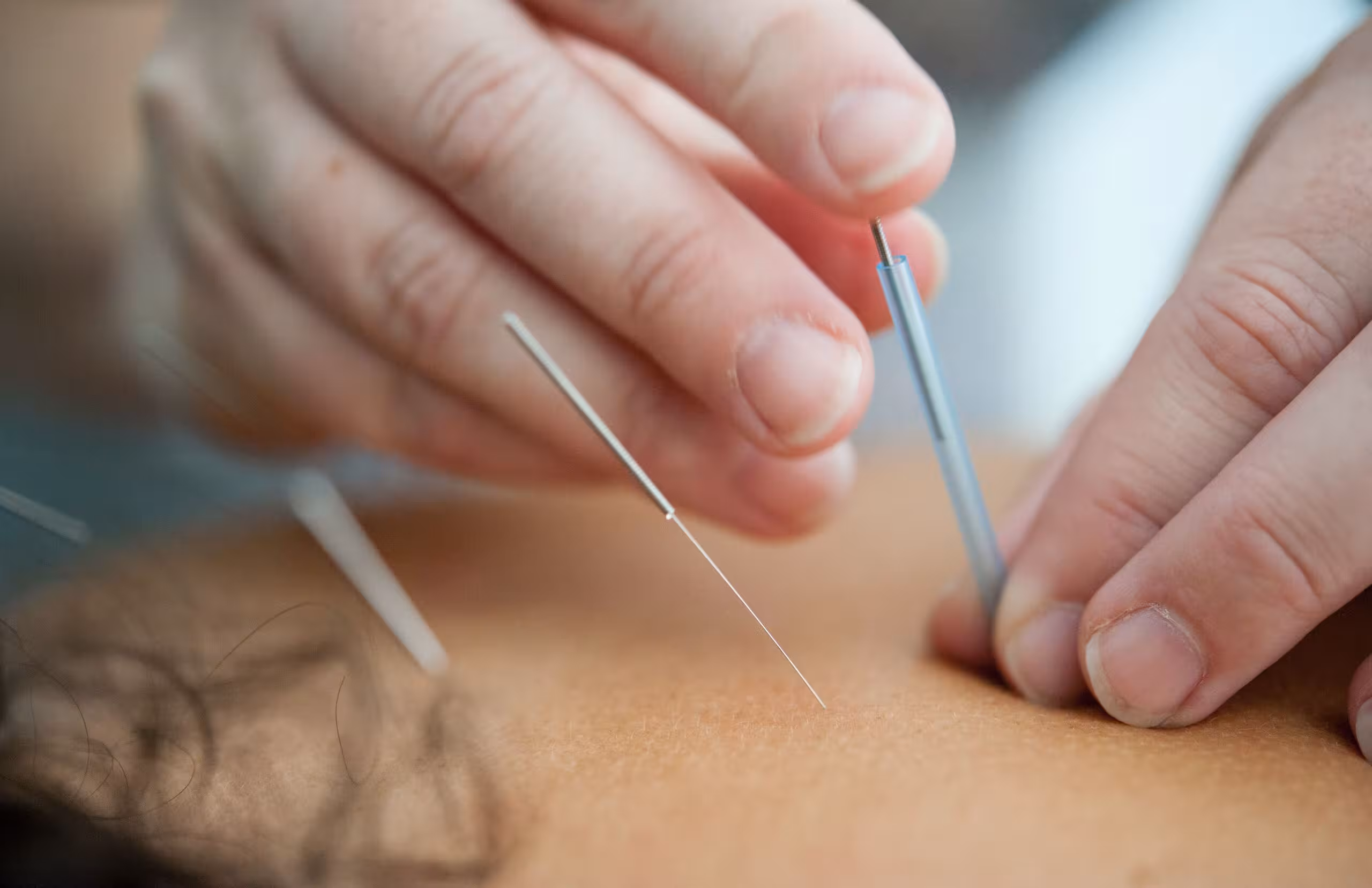 Two hands inserting an acupuncture needle into someone's back. Two additional acupuncture needles have already been inserted